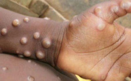 രാജ്യത്ത് എംപോക്‌സ് സ്ഥിരീകരിച്ചു; നിരീക്ഷണത്തിലായിരുന്ന യുവാവില്‍ വൈറസ് ബാധയെന്ന് കണ്ടെത്തല്‍